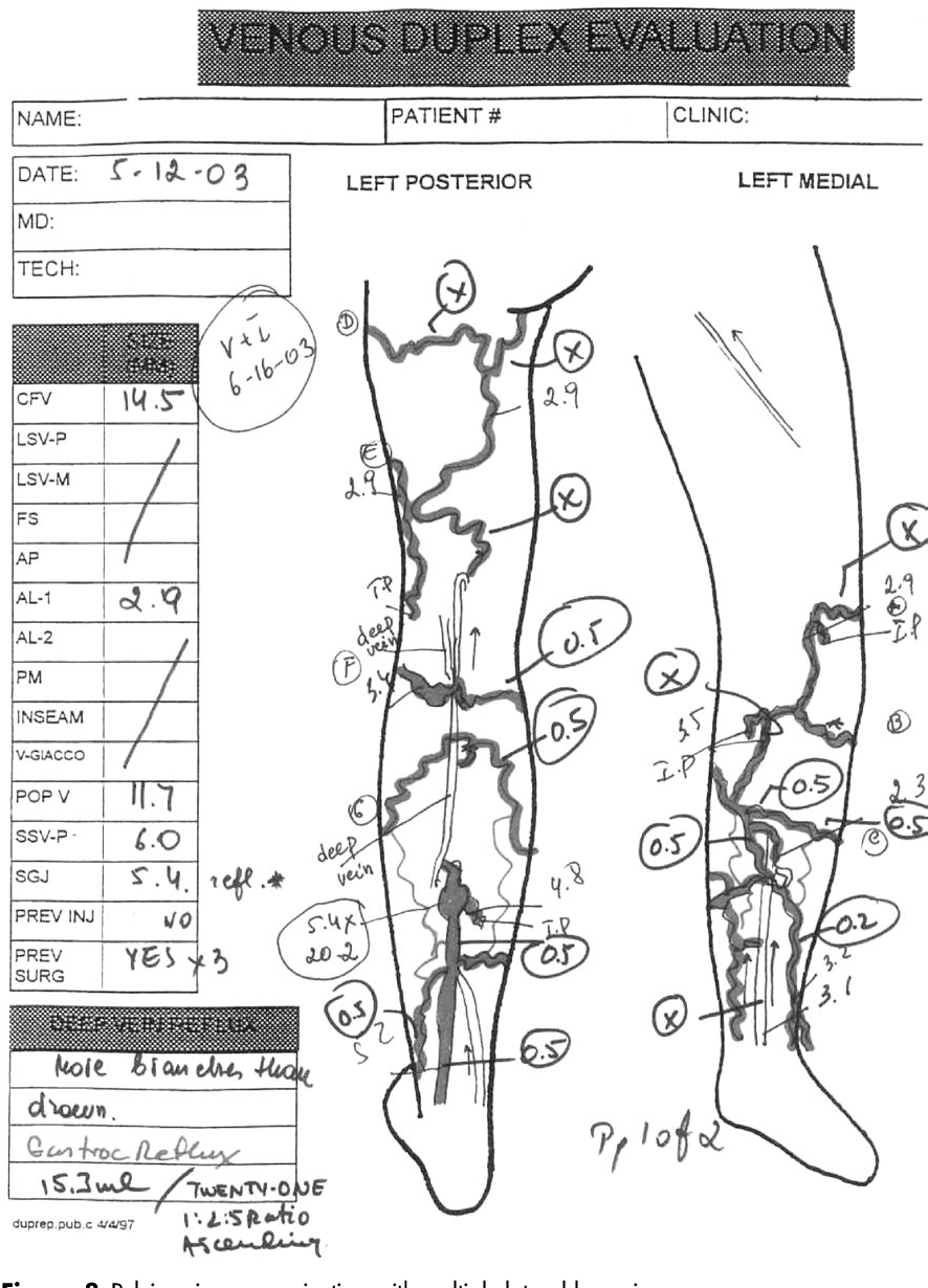 Management Of Venous Malformations In Klippel Trenaunay Syndrome With Ultrasound Guided Foam Sclerotherapy Semantic Scholar Management Of Venous Malformations In Klippel Trenaunay Syndrome With Ultrasound Guided Foam Sclerotherapy Semantic Scholar